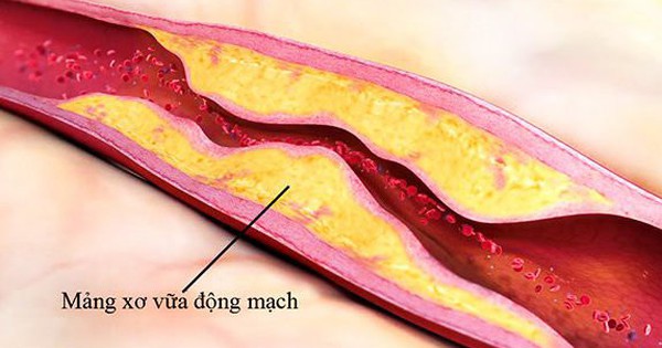 Các yếu tố nguy cơ đột quỵ và cách kiểm soát không dùng thuốc