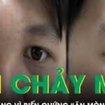 Mũi chảy mủ 4 ngày, nam thanh niên 20 tuổi suýt mất mạng