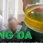 Vàng da, tắc mật do sán ký sinh trong đường mật gan