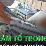 Nhét đùi ếch sống vào răng, người phụ nữ 61 tuổi bị sán ký sinh, làm tổ trong não