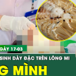 Bản tin Y tế 17/3: Rùng mình rận mu ký sinh dày đặc trên lông mi người phụ nữ