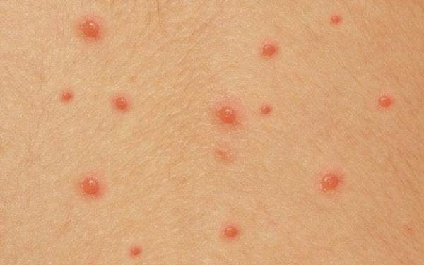 Cẩn trọng với bệnh thủy đậu gây biến chứng