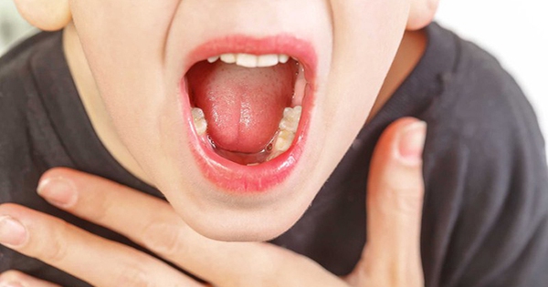 Ngoài dấu hiệu sốt, khi viêm amidan ở trẻ có thêm biểu hiện gì?