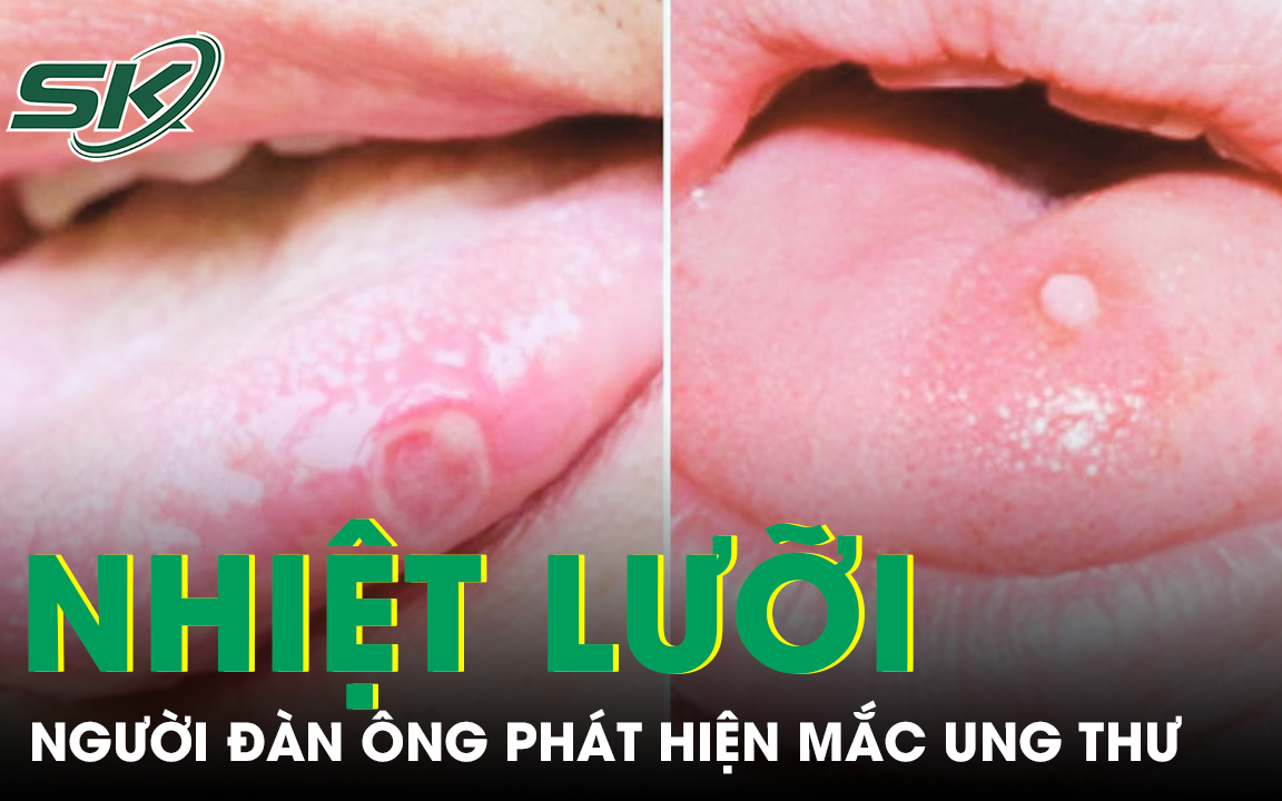 6 lưu ý về lưỡi bản đồ ở trẻ em- Ảnh 2.