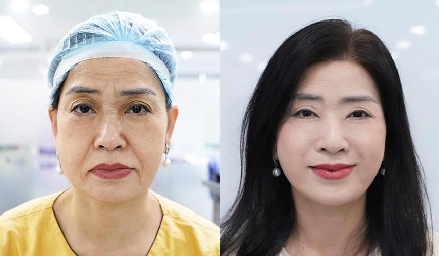 Căng da mặt - khi trẻ hóa không còn là 'kéo da' đơn thuần- Ảnh 2. Căng da mặt - khi trẻ hóa không còn là 'kéo da' đơn thuần- Ảnh 2.