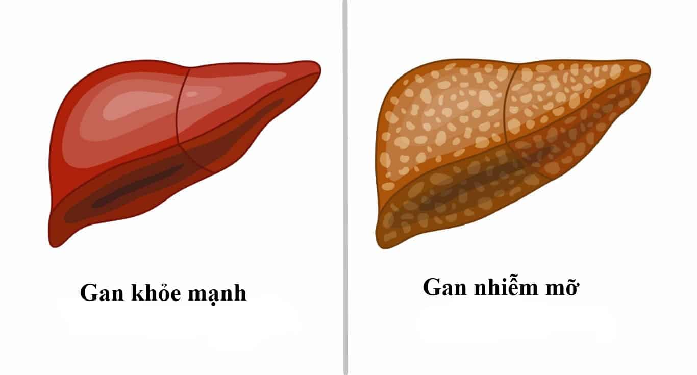 Không uống rượu bia, vì sao vẫn bị gan nhiễm mỡ?- Ảnh 2.