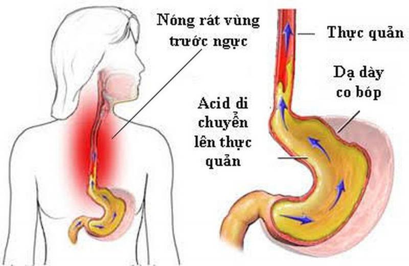 Bị trào ngược dạ dày có nên uống nghệ mật ong?- Ảnh 1. Bị trào ngược dạ dày có nên uống nghệ mật ong?- Ảnh 1.