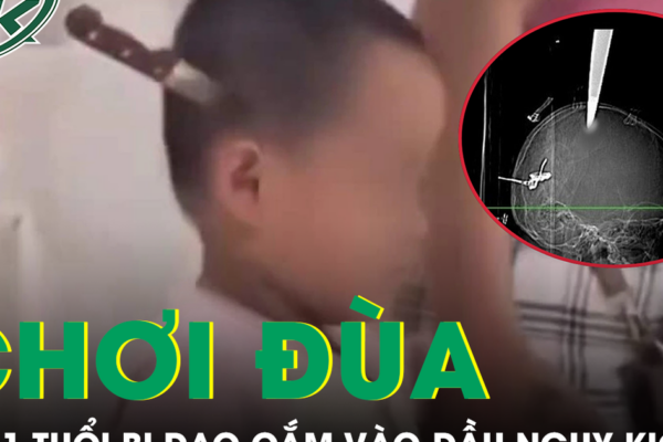 Hai anh em chơi đùa tại nhà, bé 11 tuổi bị dao cắm vào đầu nguy kịch