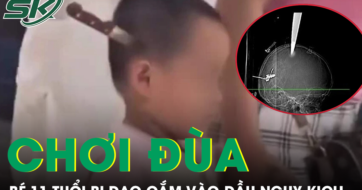 Hai anh em chơi đùa tại nhà, bé 11 tuổi bị dao cắm vào đầu nguy kịch