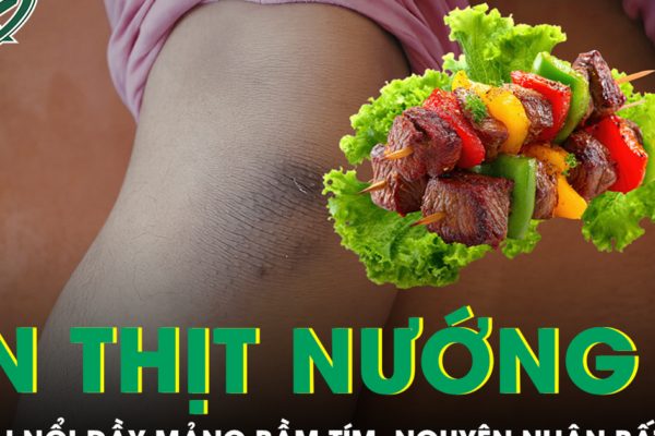 Bé trai nổi đầy mảng bầm tím sau bữa ăn thịt nướng, bác sĩ phát hiện nguyên nhân bất ngờ