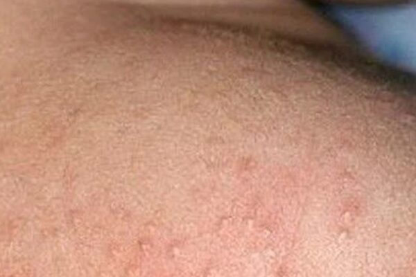 Mùa hè nhiều rôm sảy cần xử trí ra sao?