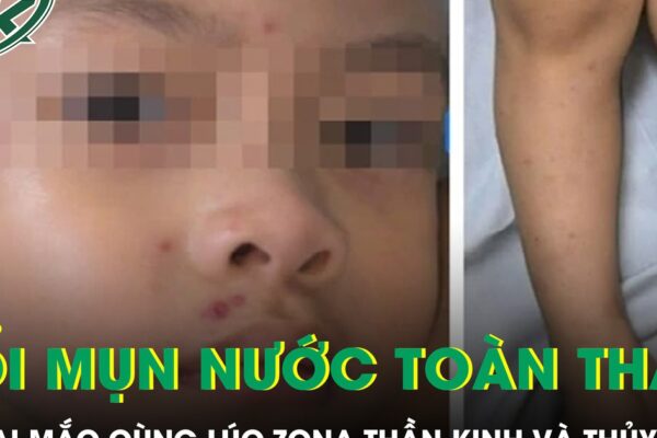 Bé trai 4 tuổi nổi kín mụn nước toàn thân sau khi mắc cùng lúc zona thần kinh và thủy đậu