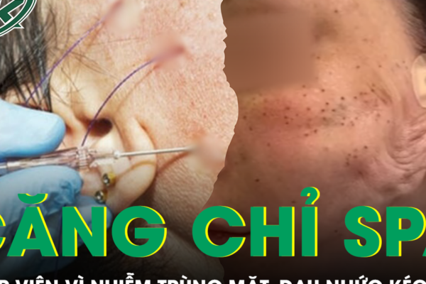 Căng chỉ nâng cơ ở spa, người phụ nữ nhập viện vì nhiễm trùng mặt