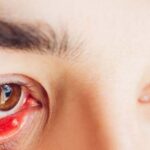 Nguyên nhân gây cộm mắt và cách khắc phục