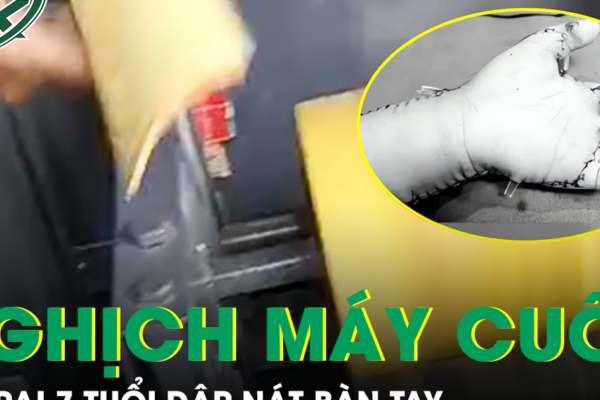 Bé 7 tuổi ở Lào Cai bị máy cuốn dập nát bàn tay do nghịch máy bào quế tự chế