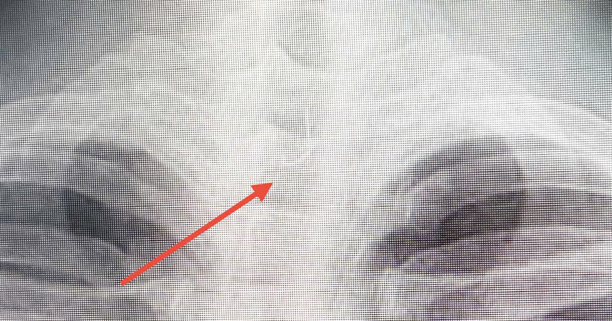 Sau ăn cá người đàn ông 46 tuổi bị mắc lưỡi câu sâu trong thực quản