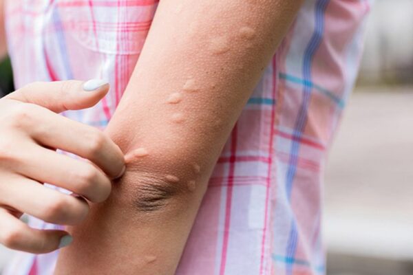 Mề đay dễ bùng phát khi nắng nóng: 3 cách làm giảm ngứa, dịu da