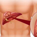 Người mắc viêm gan B sẽ rất nguy hiểm nếu tự ý làm điều này