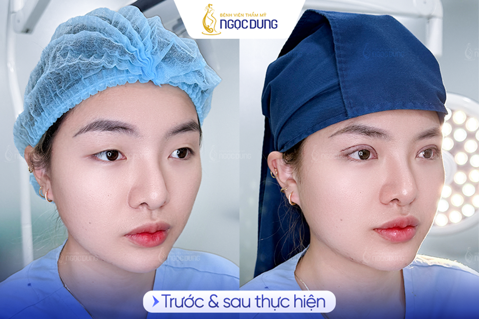 picture3-1779436574285631780151 Có nên cắt mí mắt? Phân tích từ chuyên gia- Ảnh 3.