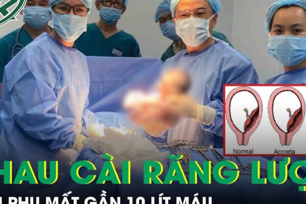 Thai phụ 36 tuần mất gần 10 lít máu, nguy hiểm tính mạng vì tai biến nhau cài răng lược
