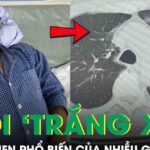 Tưởng cảm cúm, người đàn ông bất ngờ suy đa tạng, phổi ‘trắng xoá’ vì thói quen nhiều người mắc