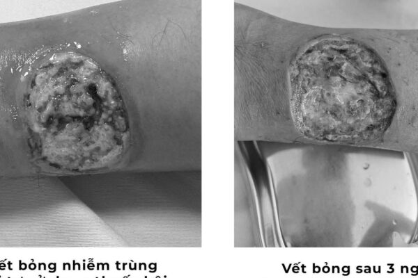 Tự chữa bỏng bằng thuốc dân gian, người đàn ông suýt hoại tử chân