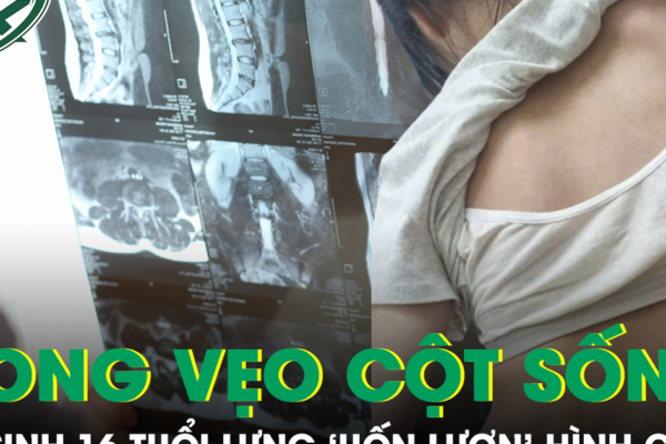 Tự ý ngừng đeo nẹp vì sợ bạn bè trêu chọc, nữ sinh 16 tuổi đối mặt nguy cơ mổ cột sống