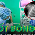 Nuốt phải bông tai kim loại, bé gái 11 tháng tuổi đối mặt nguy cơ thủng thực quản