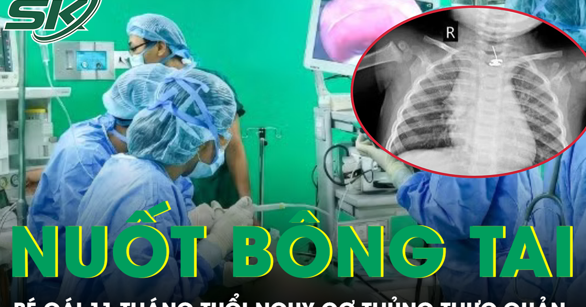 Nuốt phải bông tai kim loại, bé gái 11 tháng tuổi đối mặt nguy cơ thủng thực quản