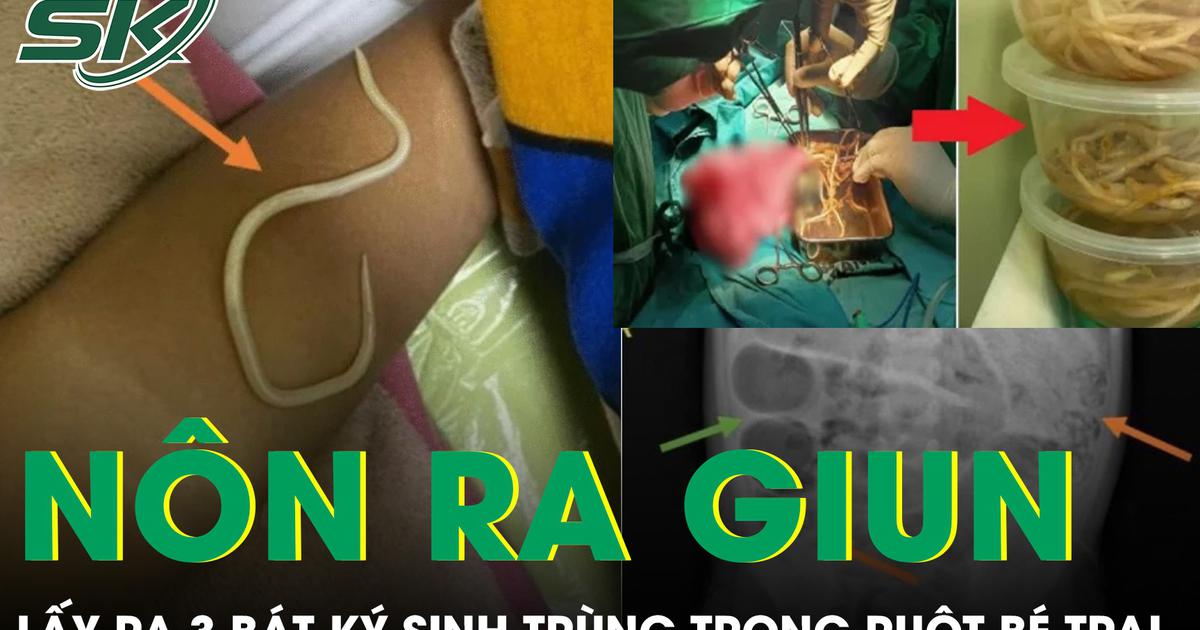Bé trai 3 tuổi nôn ra giun, bác sĩ phẫu thuật lấy ra 3 bát ký sinh trùng trong ruột