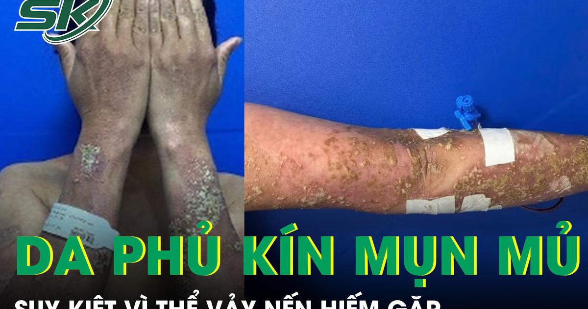 Da phủ kín mụn mủ, nữ bệnh nhân 28 tuổi suy kiệt vì thể vảy nến hiếm gặp