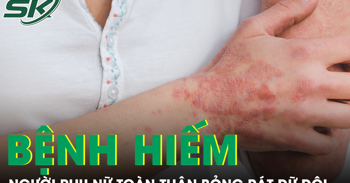 Căn bệnh hiếm khiến người phụ nữ sốt cao, toàn thân đỏ rực và bỏng rát dữ dội