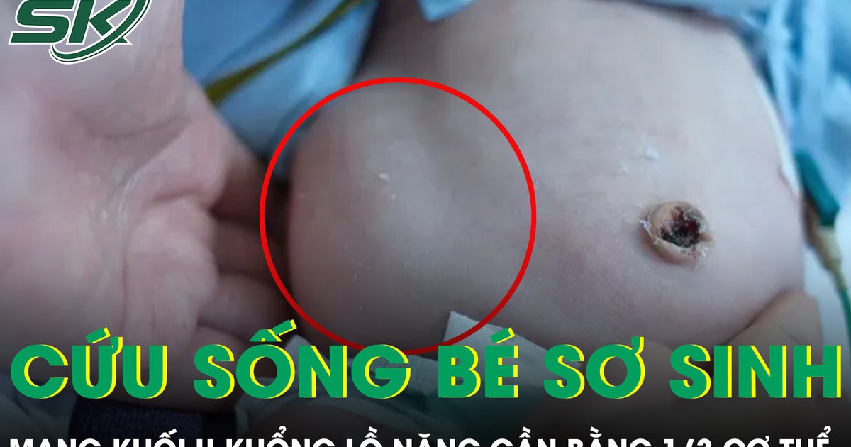 Cứu sống bé sơ sinh mang khối u khổng lồ nặng gần bằng 1/3 cơ thể