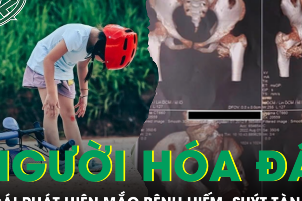 Bé gái cứng khớp suốt 2 năm sau cú ngã nhẹ, bác sĩ phát hiện mắc bệnh ‘người hóa đá’