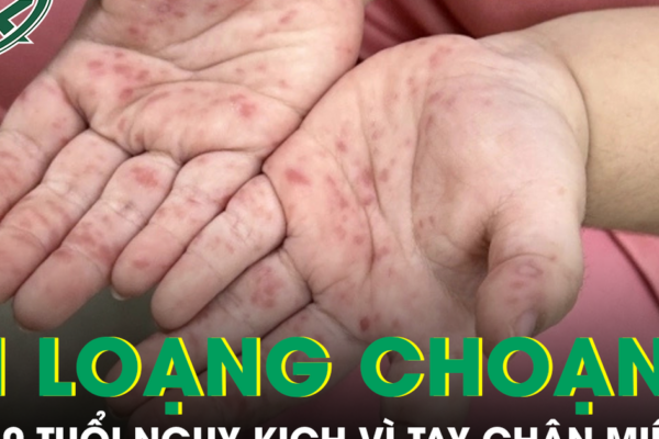 Tưởng bệnh nhẹ, bé gái 10 tuổi nhập viện nguy kịch vì tay chân miệng biến chứng thần kinh