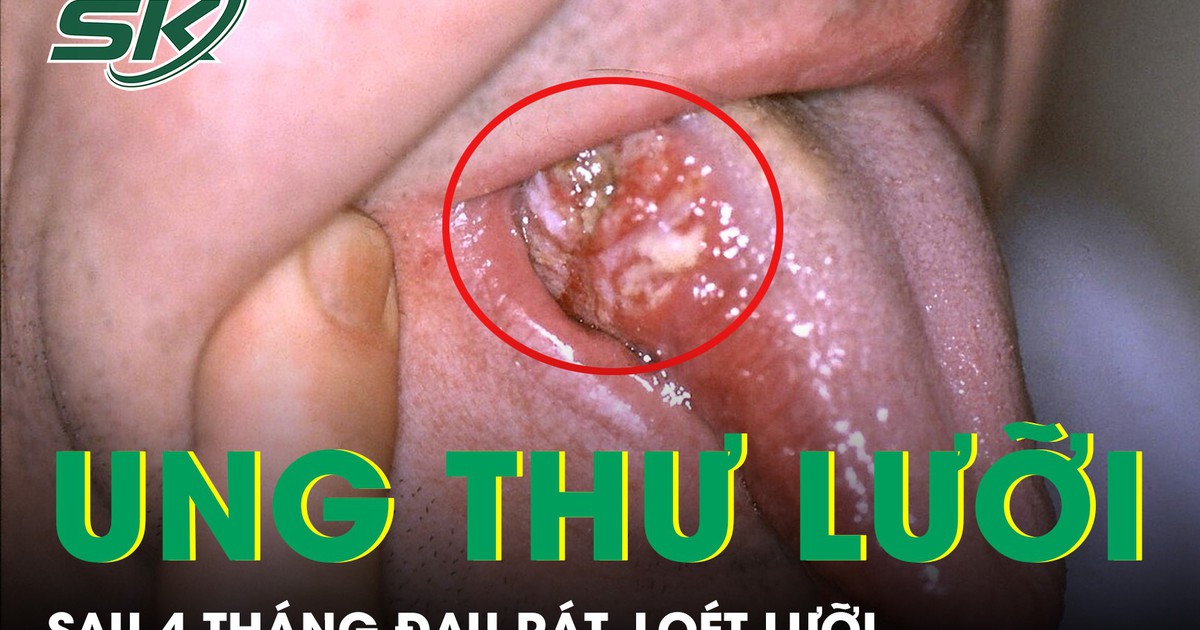 Loét lưỡi suốt 4 tháng, người đàn ông phát hiện ung thư ở tuổi 33