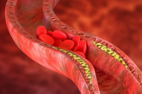 Thay đổi lối sống giúp kiểm soát cholesterol cao, giảm nguy cơ bệnh tim mạch