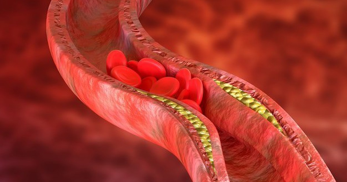 Thay đổi lối sống giúp kiểm soát cholesterol cao, giảm nguy cơ bệnh tim mạch