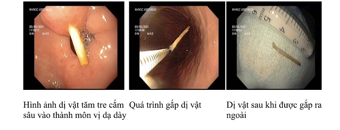 img-0797-1781698966911577429 Thói quen ngậm tăm sau ăn hệ lụy khó lường- Ảnh 1.