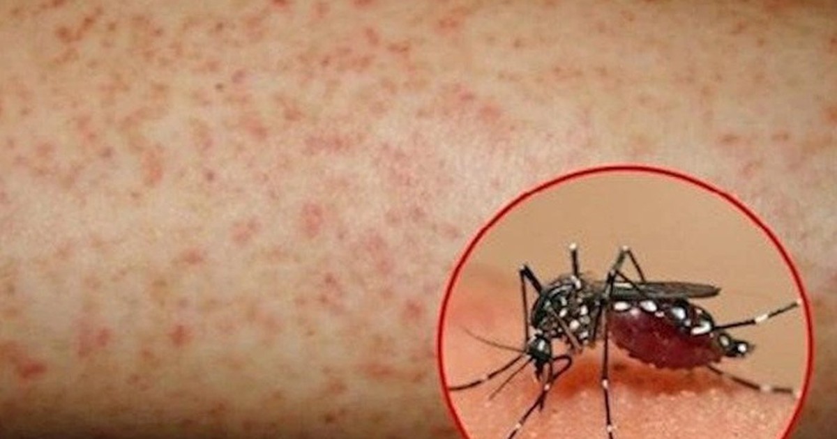 Hơn 1.100 ca mắc sốt xuất huyết, Lâm Đồng kích hoạt các biện pháp phòng, chống dịch