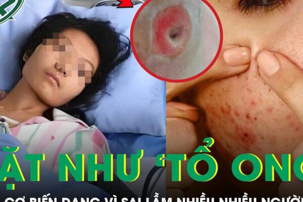 Người phụ nữ chết lặng khi thấy mặt như ‘tổ ong’, nguy cơ biến dạng vì sai lầm nhiều người mắc