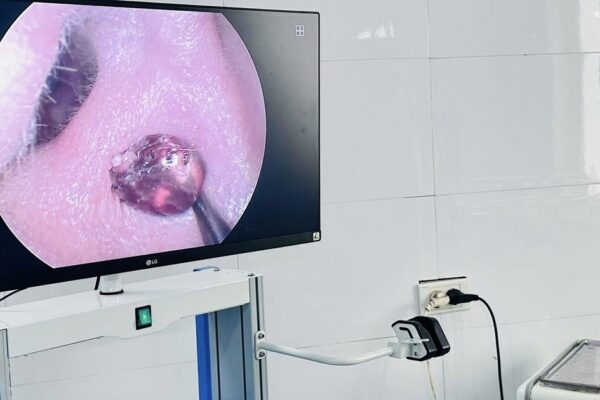 Đau nhức tai suốt một tuần, người phụ nữ tá hỏa vì ‘vị khách lạ’ trong tai