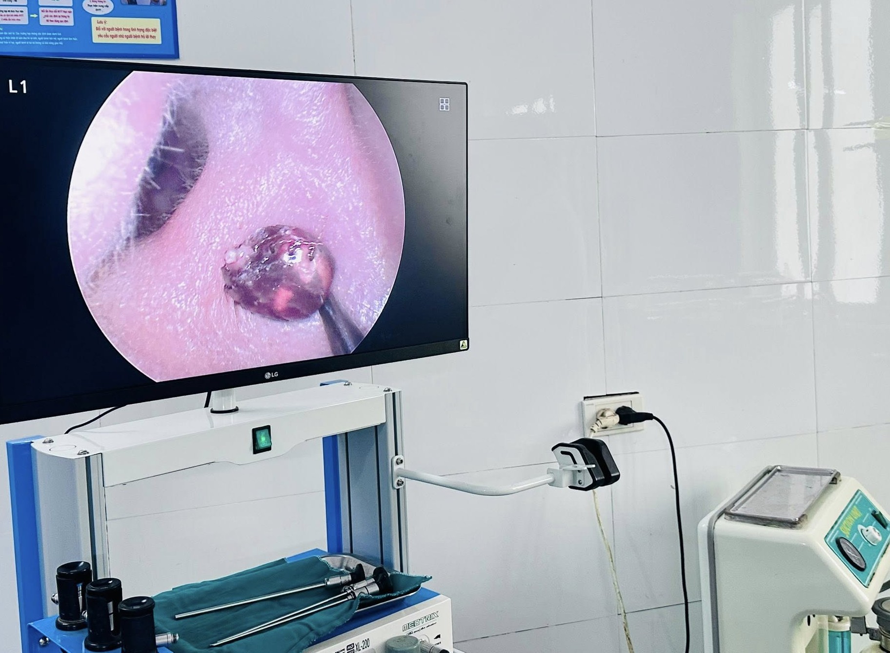 72003289716014249953202082737696224700564777n-17812572805781570442499 Đau nhức tai suốt một tuần, người phụ nữ tá hỏa vì 'vị khách lạ' trong tai- Ảnh 1.