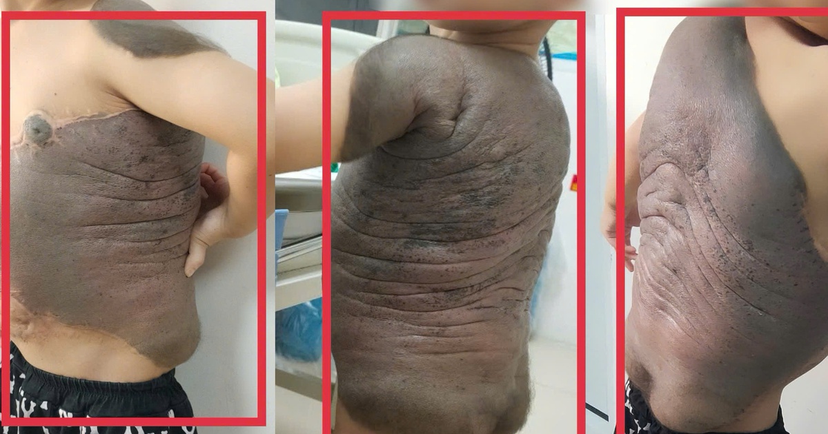 6 lần đại phẫu cắt bỏ khối u ‘mai rùa’ nặng trĩu trên lưng bé trai 7 tuổi